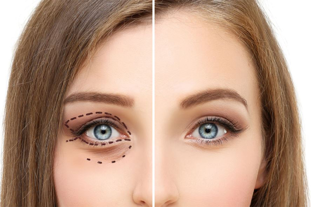 Blefaroplastika əməliyyatı və onun mümkün fəsadları